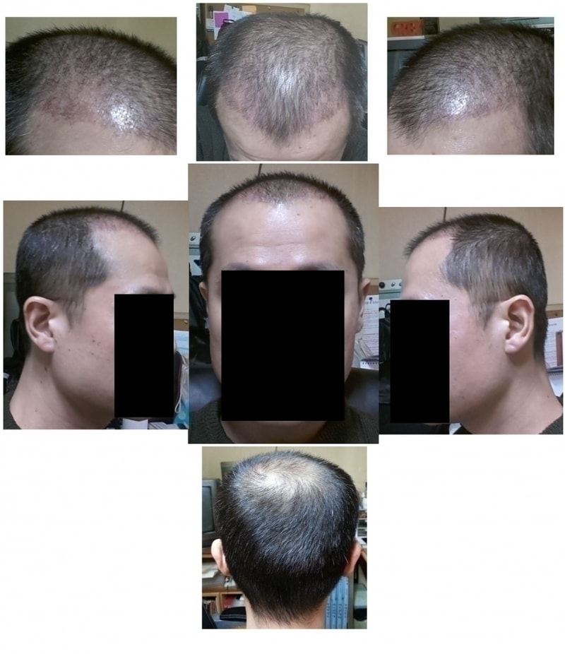 이식수술 30일차.jpg