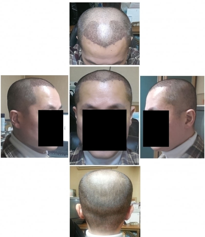 이식수술 6일차.jpg