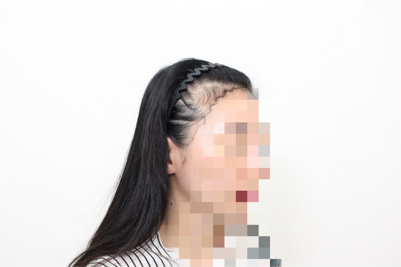 [Mopro Clinic at Sinsa Station] Hairline, review after 12 days.