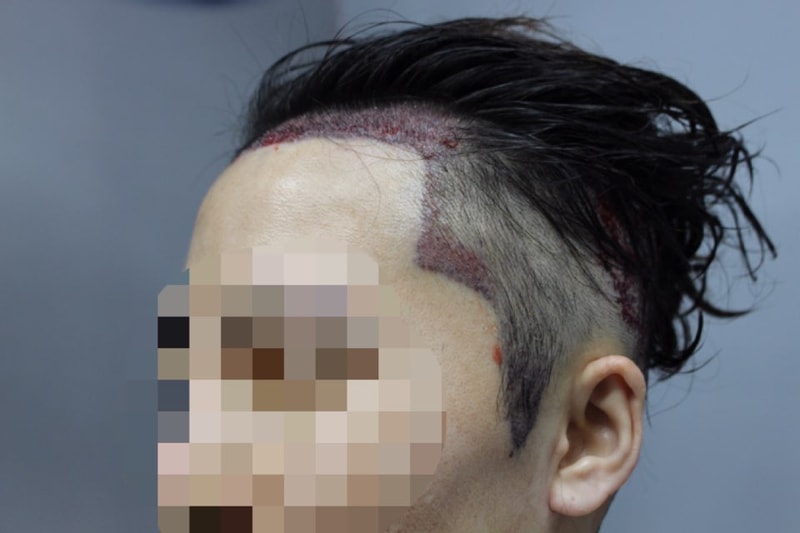 수술직후_좌.jpg