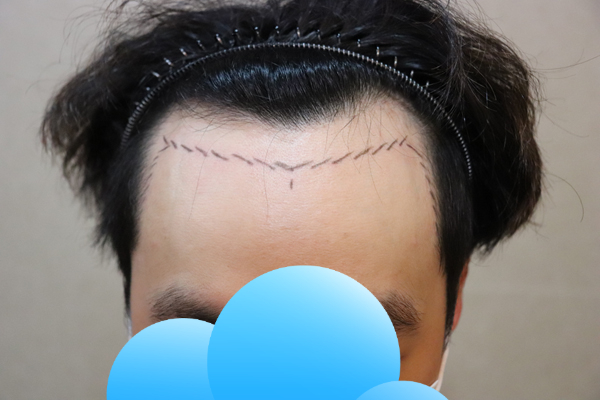 JP성형외과 비절개 3200모 13일 경과 후기 랍니다~
