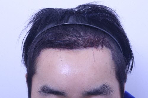 수술다음날 (1).JPG