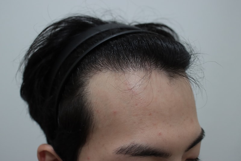 비절개 모발이식 6개월차 후기