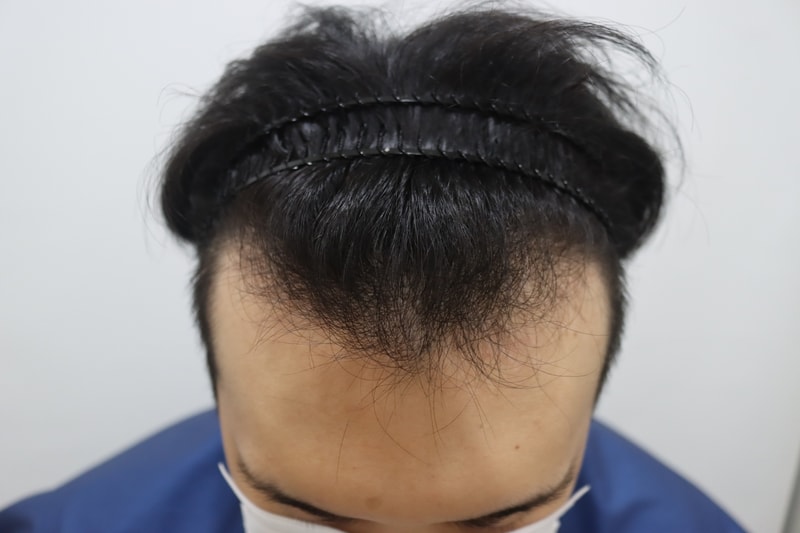 비절개 2900모 모발이식 후기
