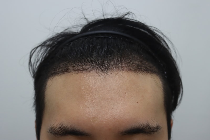 수술2주차 2.jpg