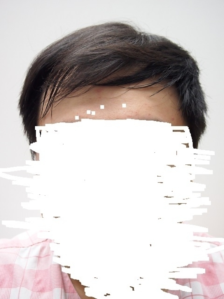 [포헤어]포헤어에서 수술 했어요 (8월28일)
