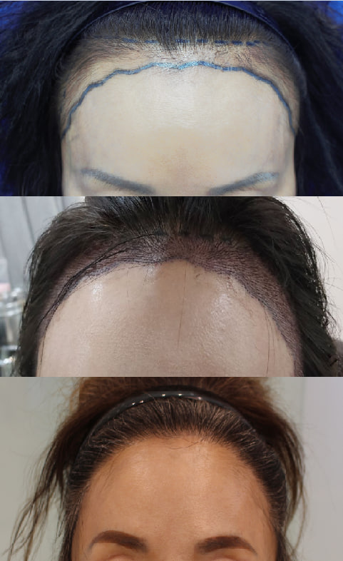 여성 헤어라인 1.jpg