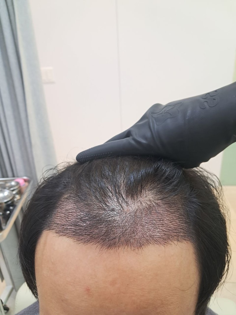 비절개2.jpg