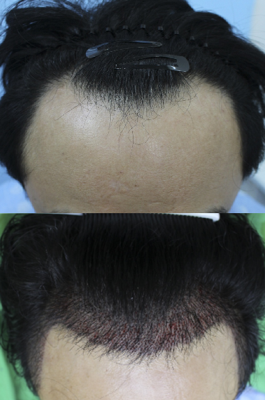 김세진 모발이식.png