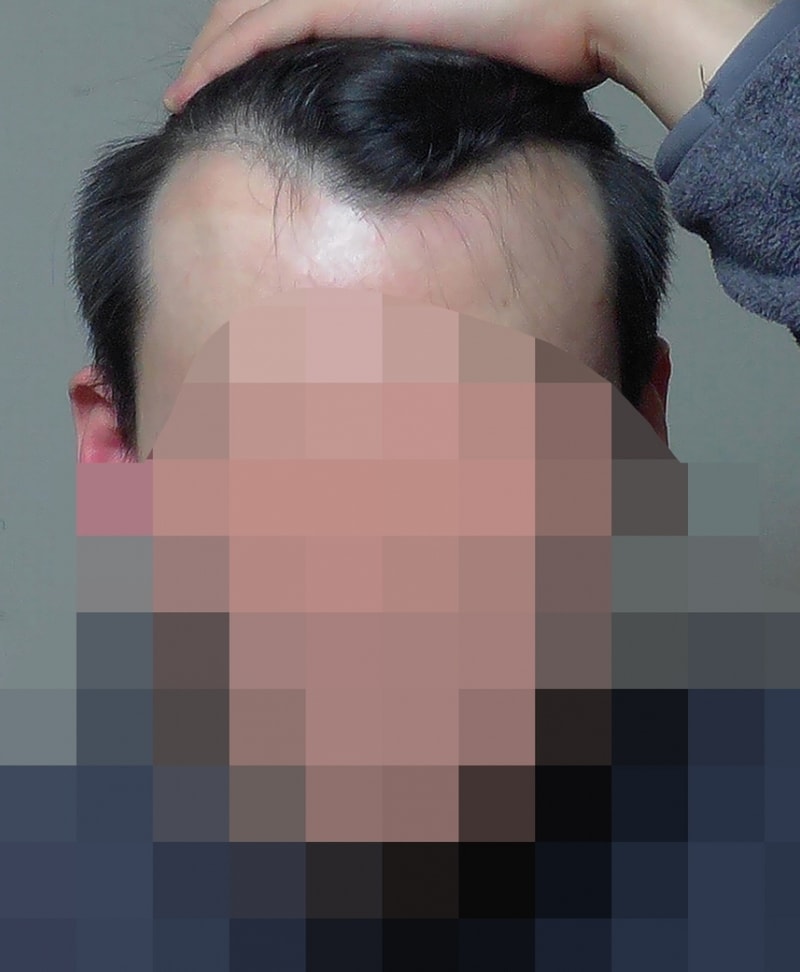 뉴헤어 2100모낭 일주일 사진후기입니다.