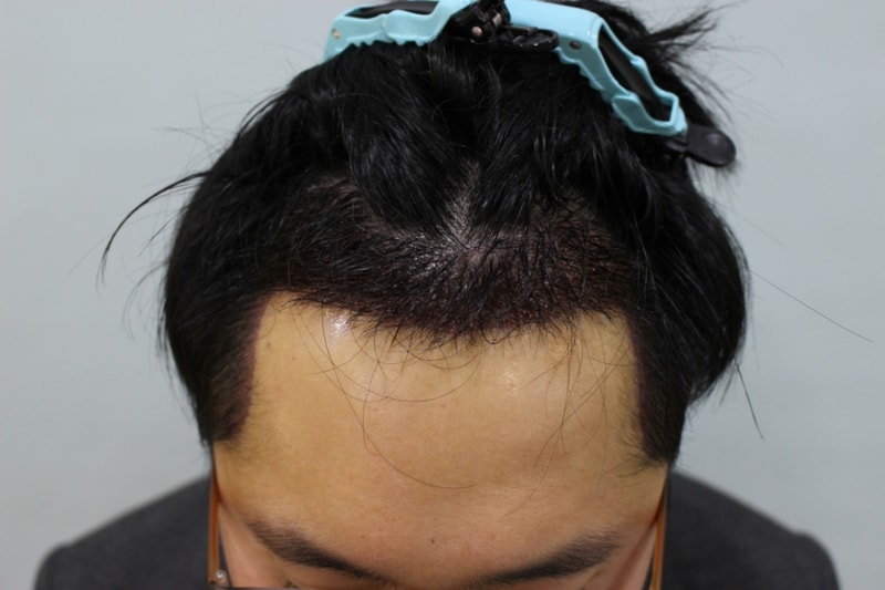 1수술후 1일.JPG