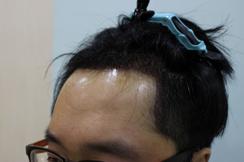 3수술후 1일.JPG