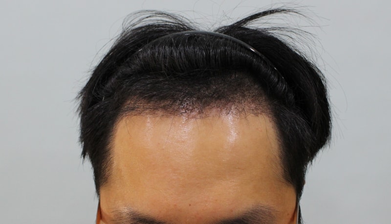 수술후 3개월 (7).jpg
