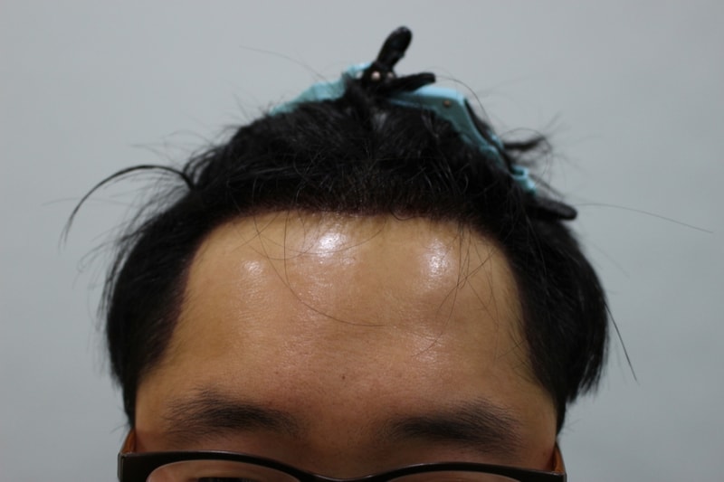 2수술후 1일.JPG