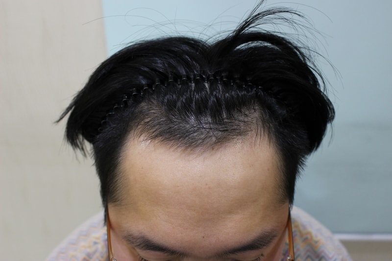 1수술전.JPG