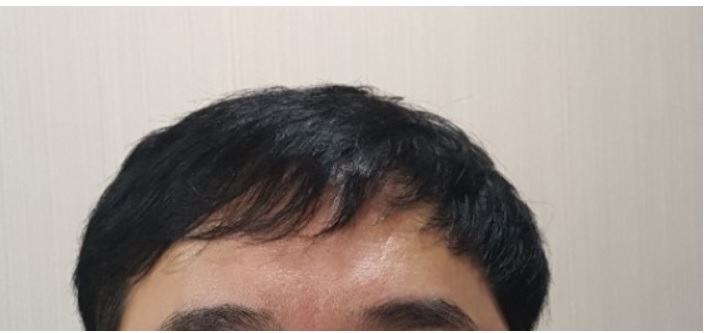 It's been about five years since I transplanted it due to hair loss. It's a review.