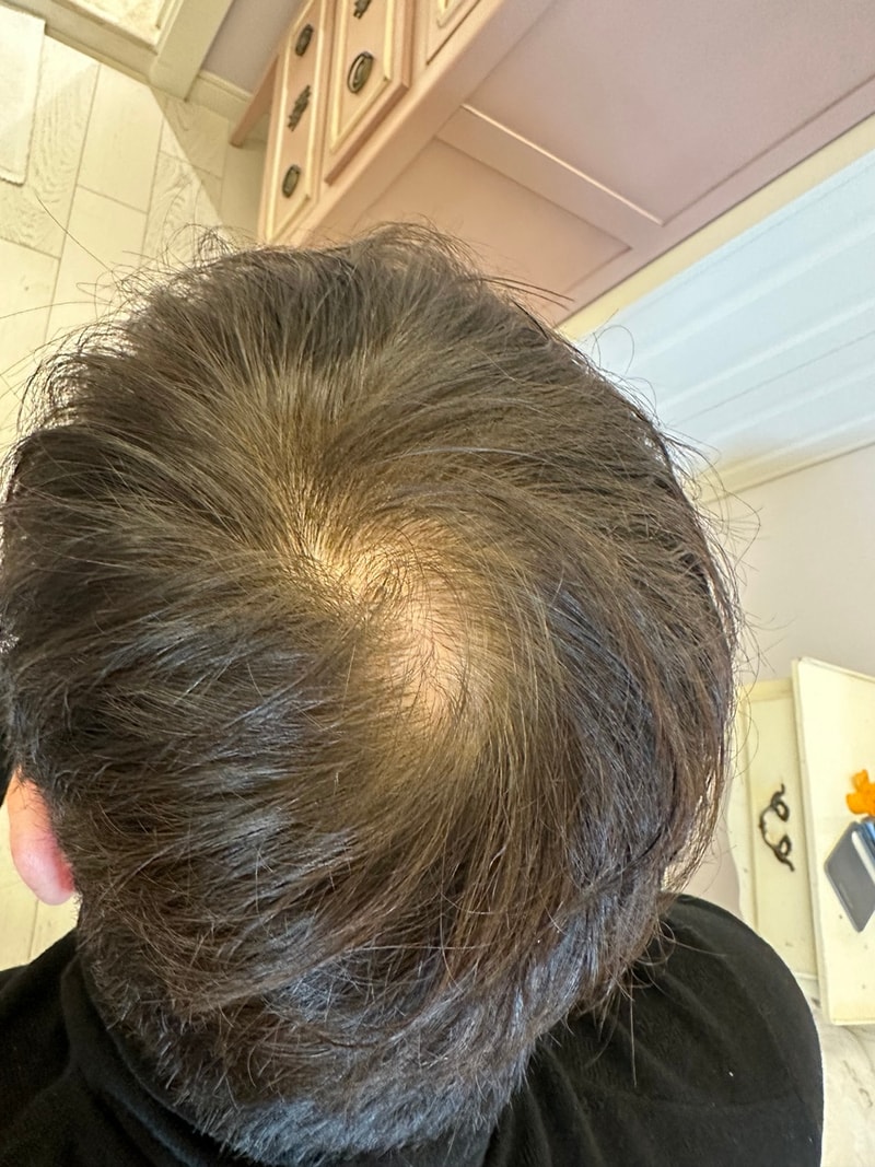It's been 50 days since 500 hair transplants on the top of the head.