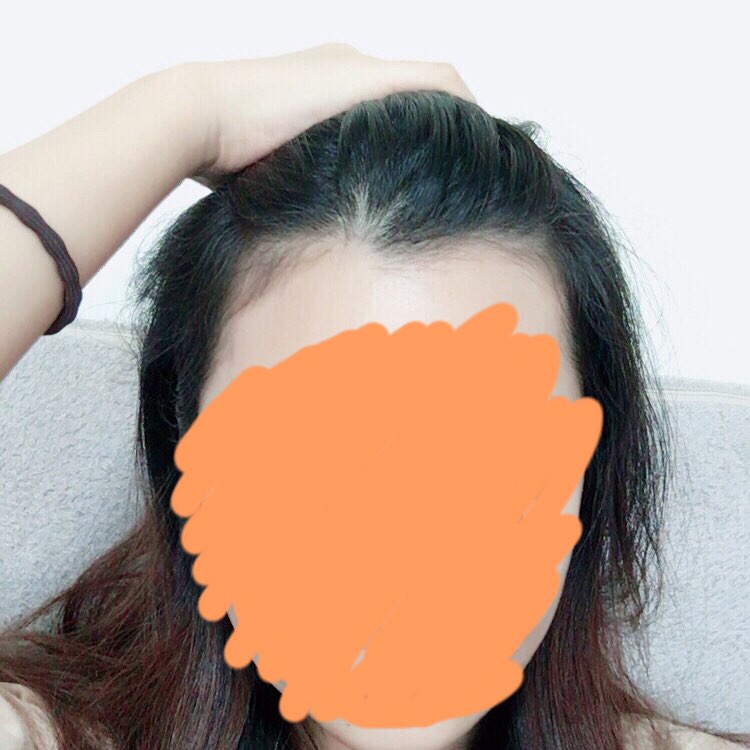 헤어라인교정 6개월차 후기 올려요~