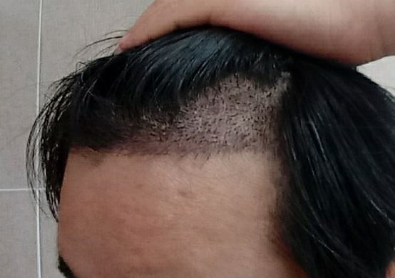 수술 15일차 좌.JPG