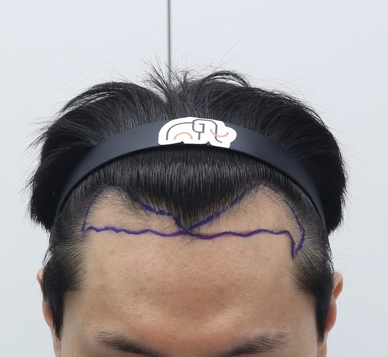수술전.jpg