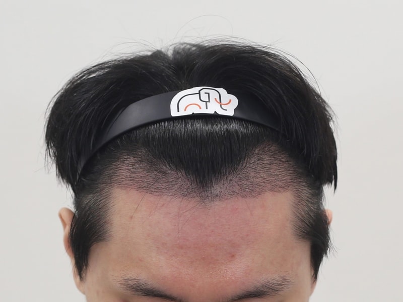 2주 경과.jpg
