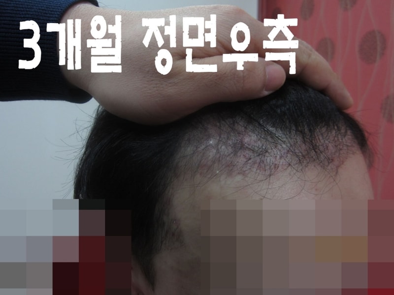3개월 우측.JPG