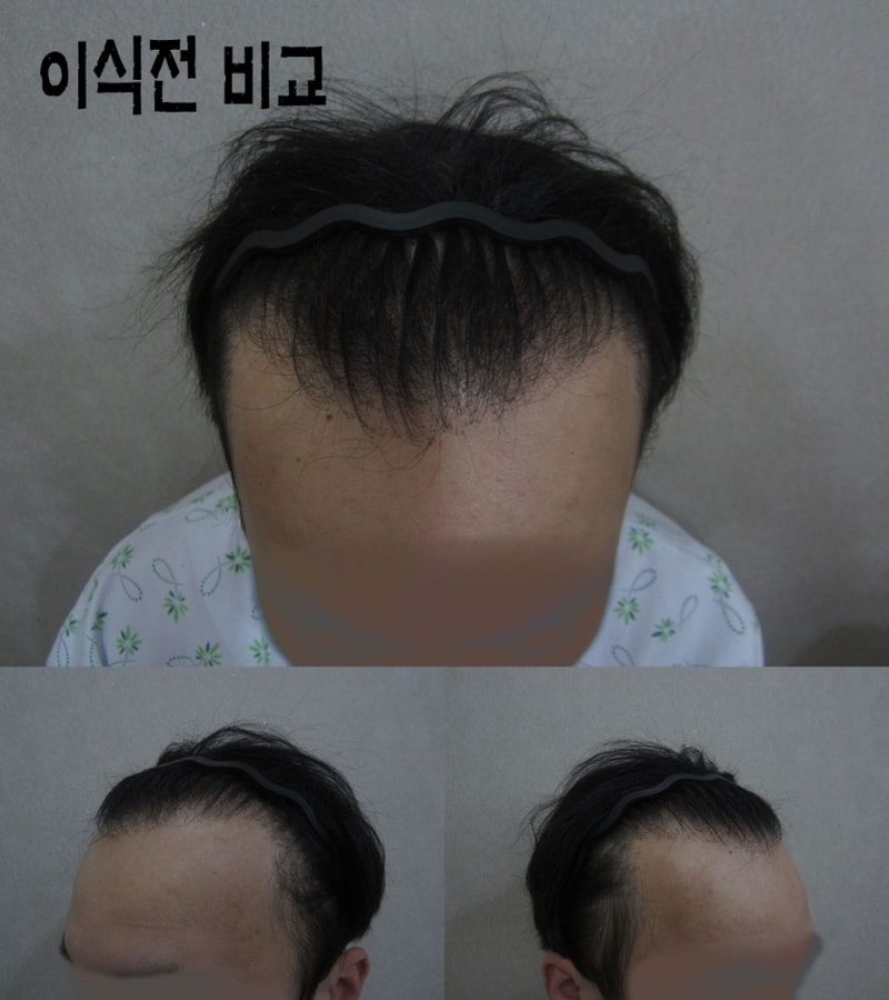 이식전 비교.jpg