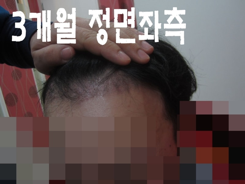 3개월 좌측.JPG