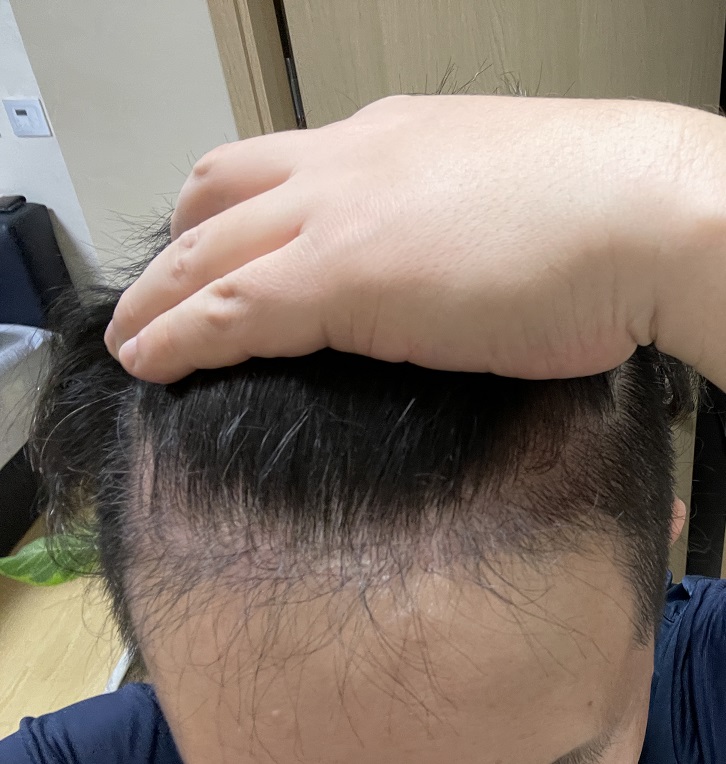 비절개 시술 4개월 경과 후기 남깁니다.