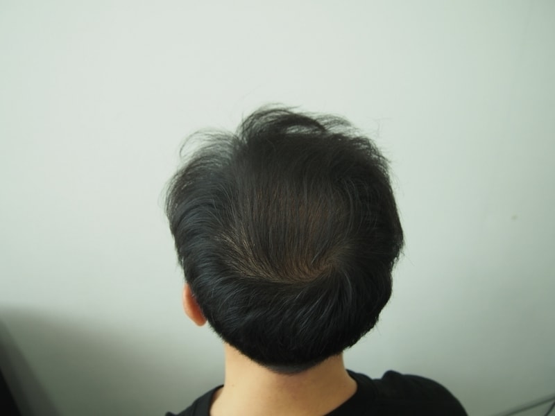 8개월차 정수리.JPG