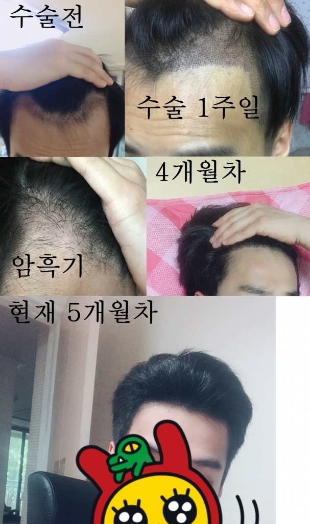 (비절개) 3000모 5개월? 정도차 (건승 한상보 배상)