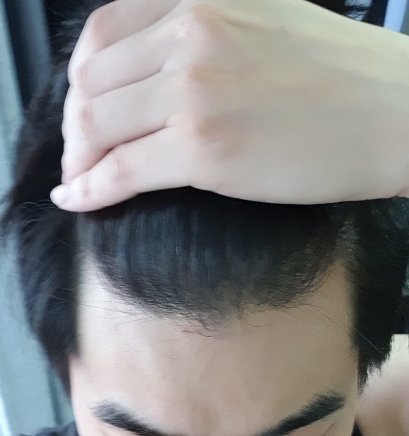 헤어라인 비절개노컷 2000모 수술후기