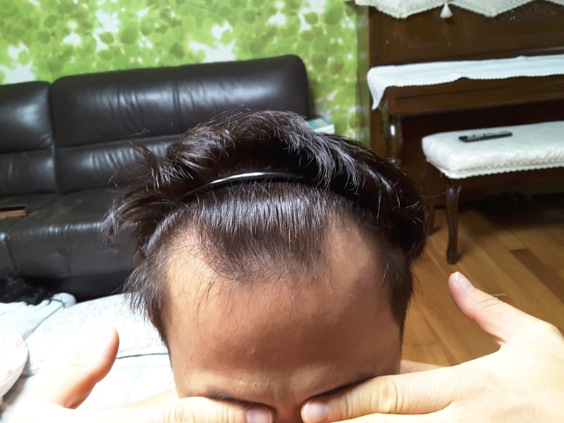 모발이식후 3개월경과 올려봅니다.