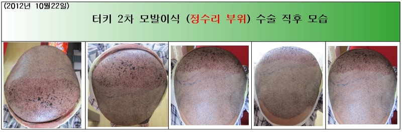3. 터키 2차 정수리수술직후(3).JPG