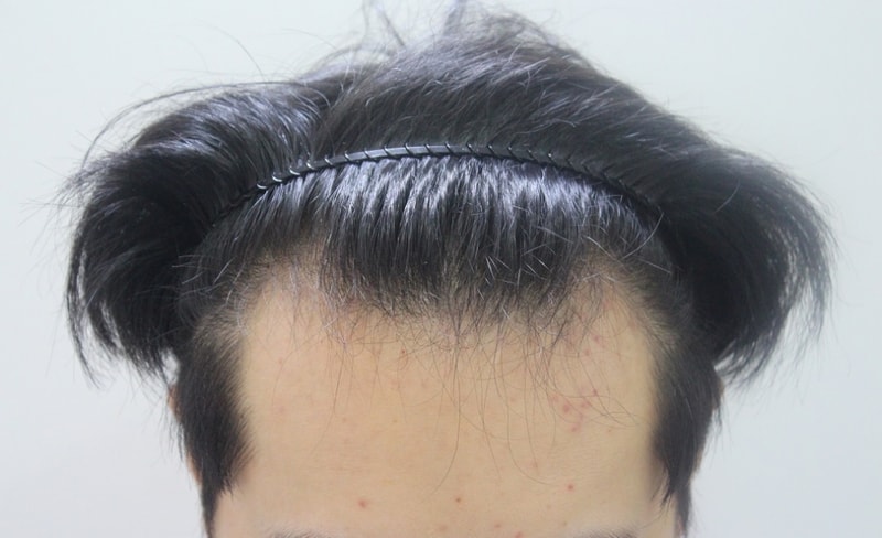 수술전.JPG