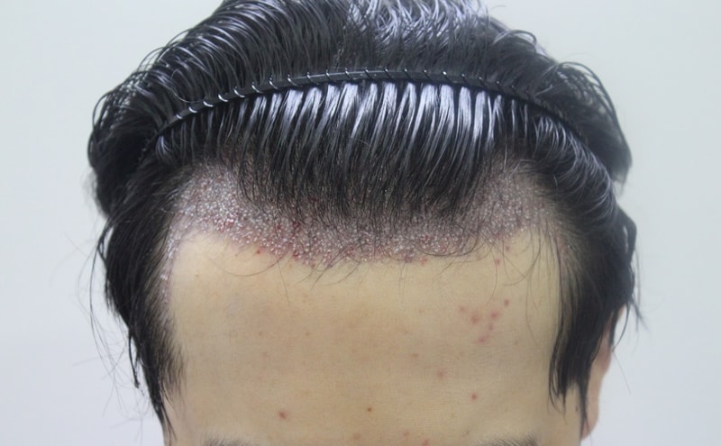 수술후.JPG