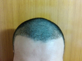 2주 경과.jpg