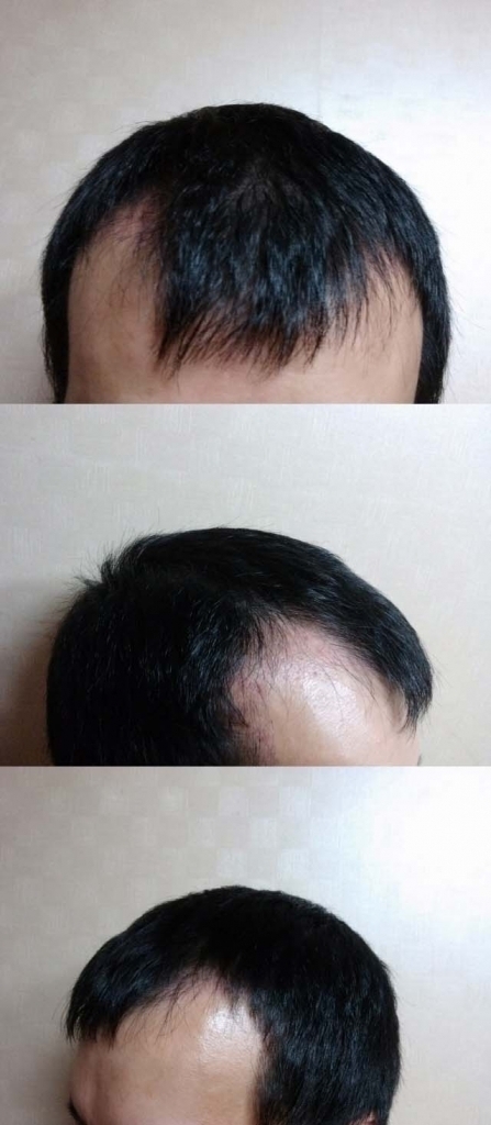 [포헤어]포헤어 비절개 100일 경과 후기입니다.