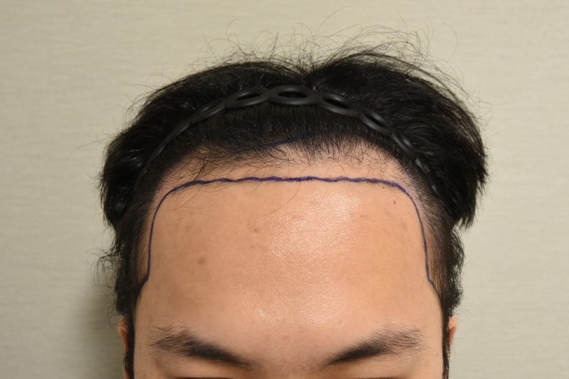 홍준현 원장님 절개 모발이식 수술 후기