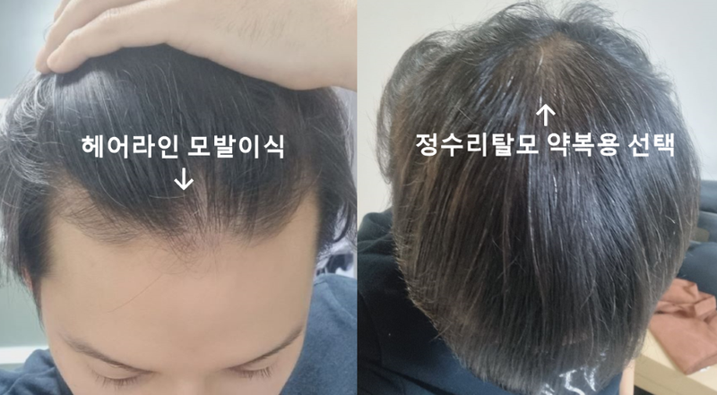 압구정 모발이식 포헤어 비절개슬릿 M자탈모 얇은모발 성공적 4개월 후기