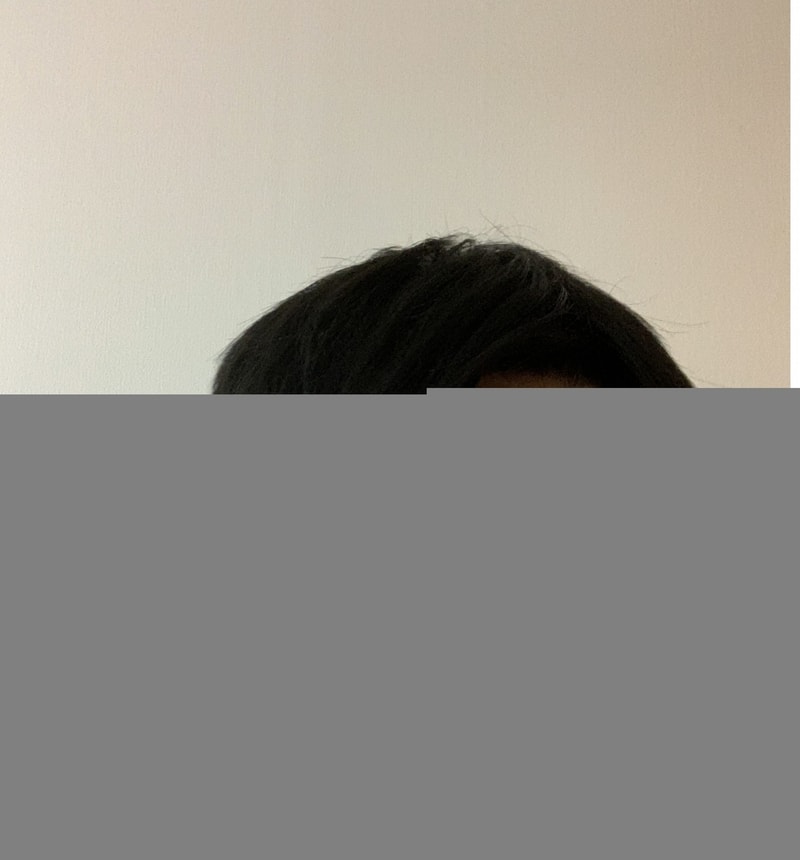 2차 시술 밀도 보강 1년 후의 머릿결 방향이 안맞음.jpg