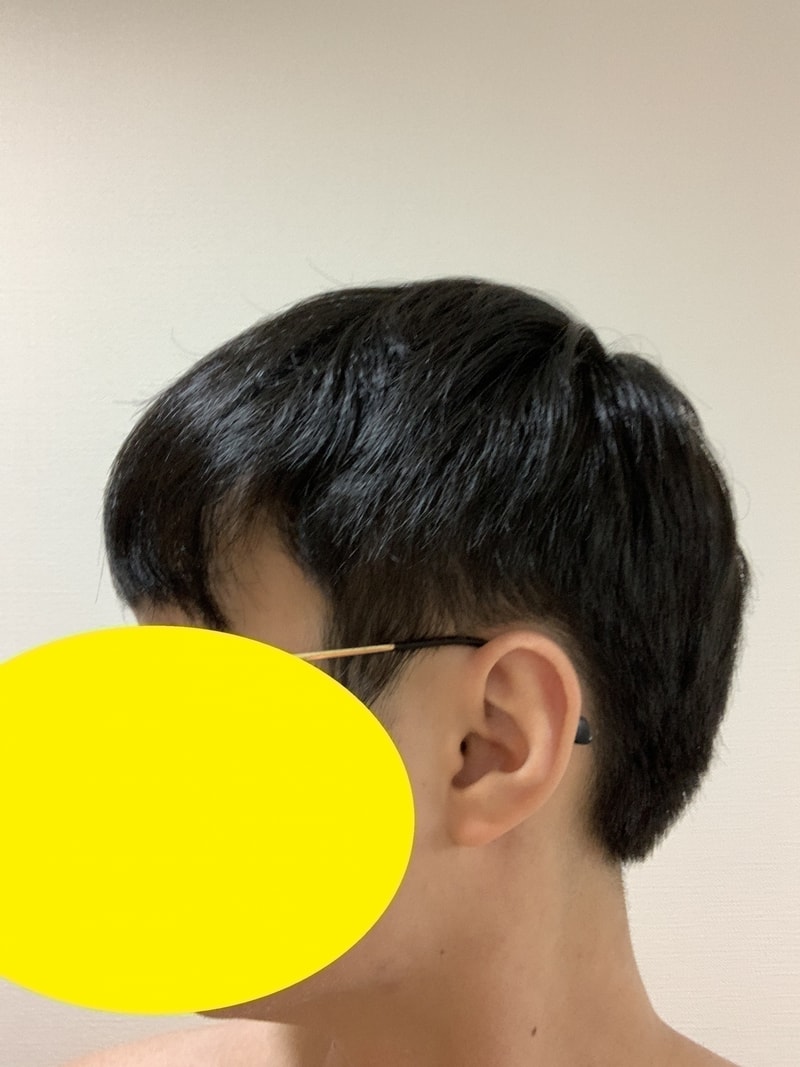 2차 시술 밀도 보강 1년 후의 오른쪽 머리 갈라짐 현상.jpg