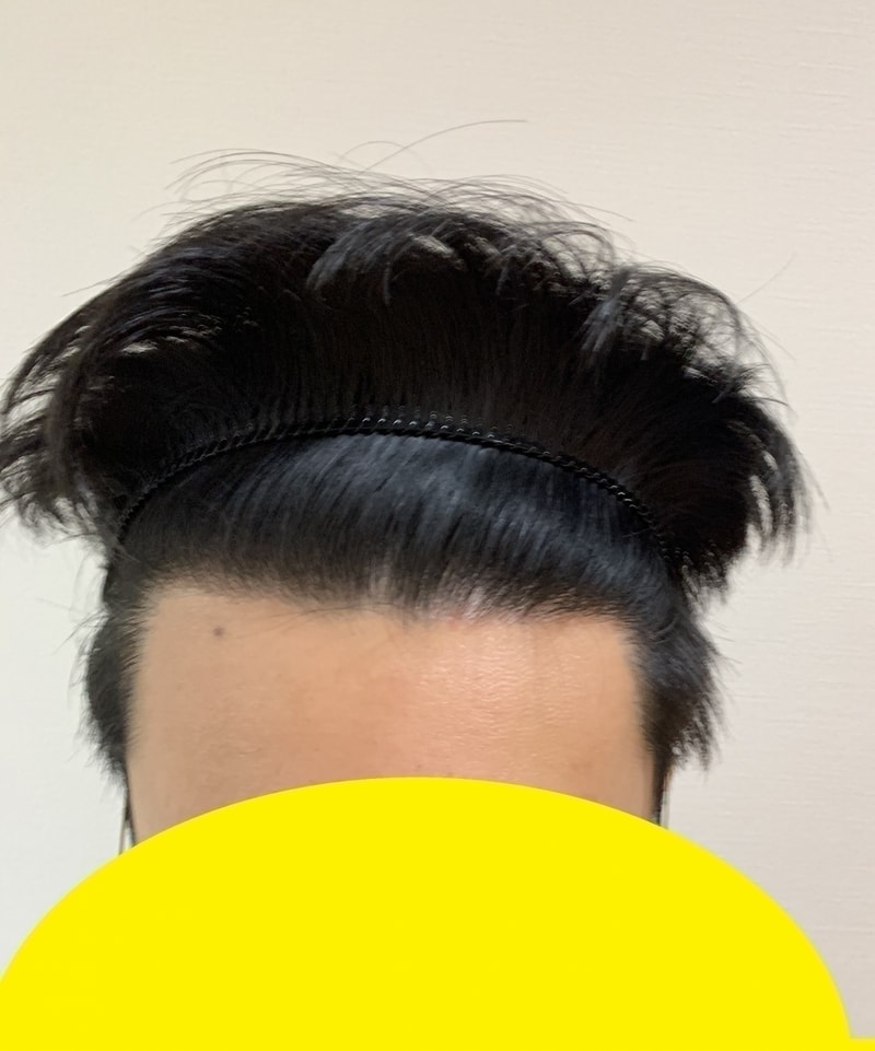 2차 시술 밀도 보강 1년 후의 비대칭.jpg