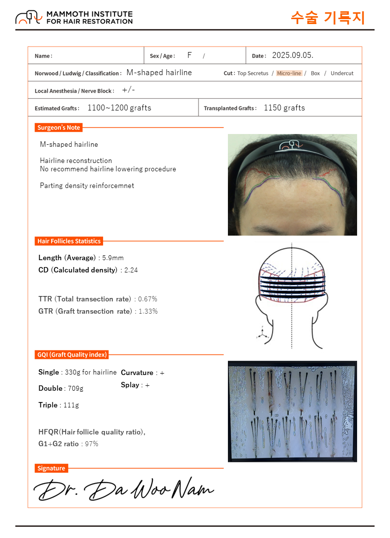 Apgujeong Mammoth Non-Cutting Hair Transplantation Review (Laugh Gas Anesthesia)