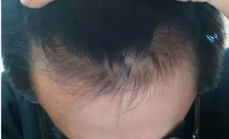모재성 비절개 1600모낭 2주차차 후기입니다