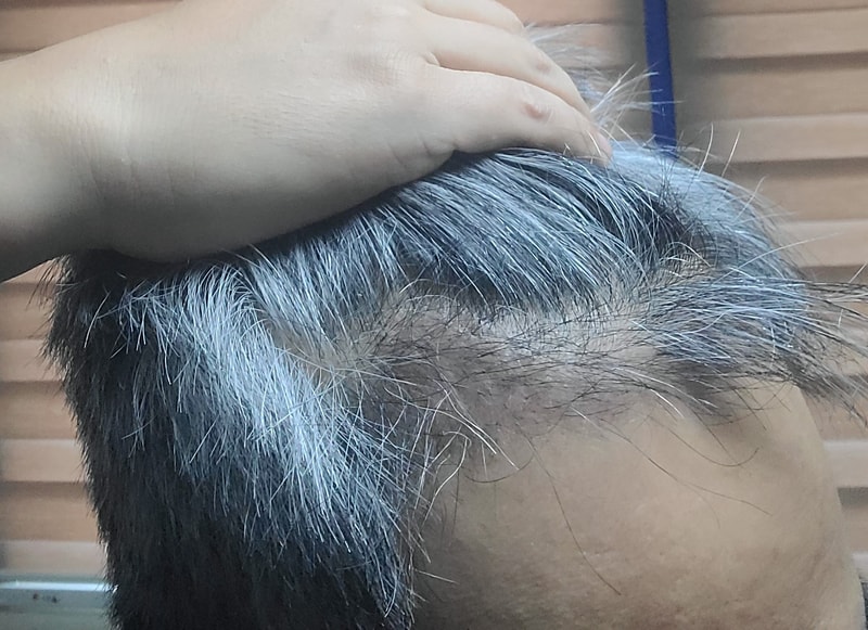 3. 수술후_3개월_셀카_3.jpg