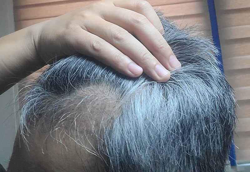 3. 수술후_3개월_셀카_2.jpg