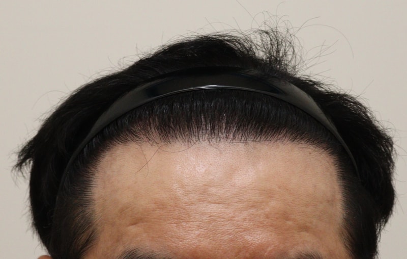 5. 수술후_1년_1.JPG