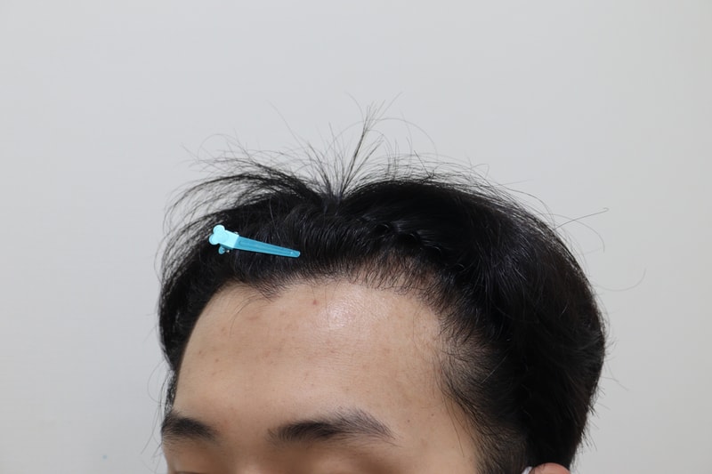 1. 수술전_2.JPG