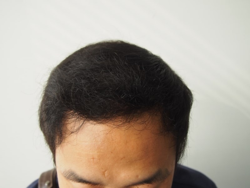 2000모 시술 8개월 후 후기입니다.